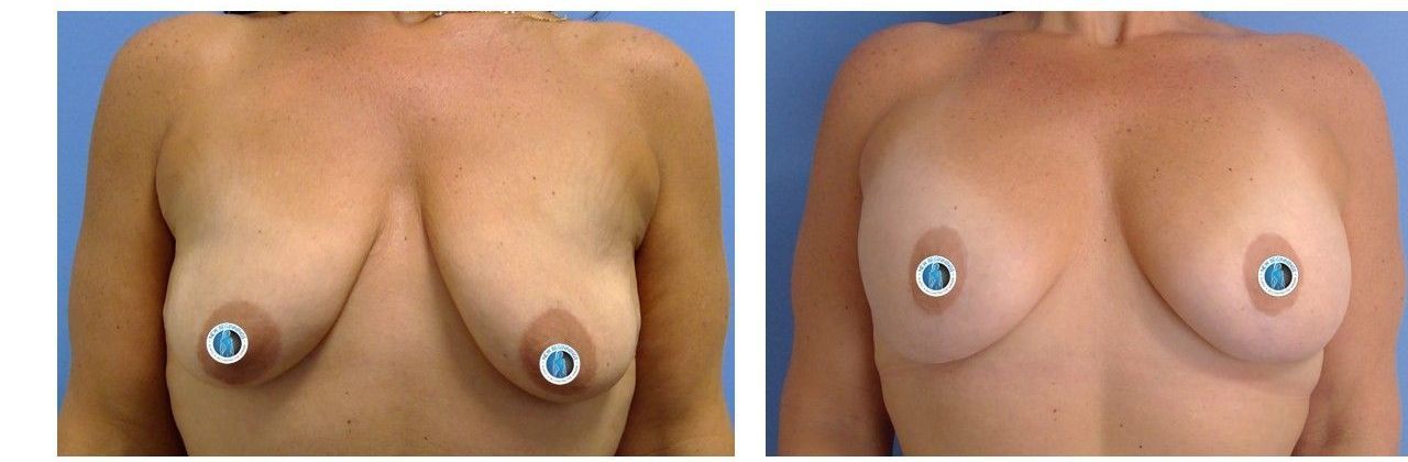 Augmentation Mastopexy