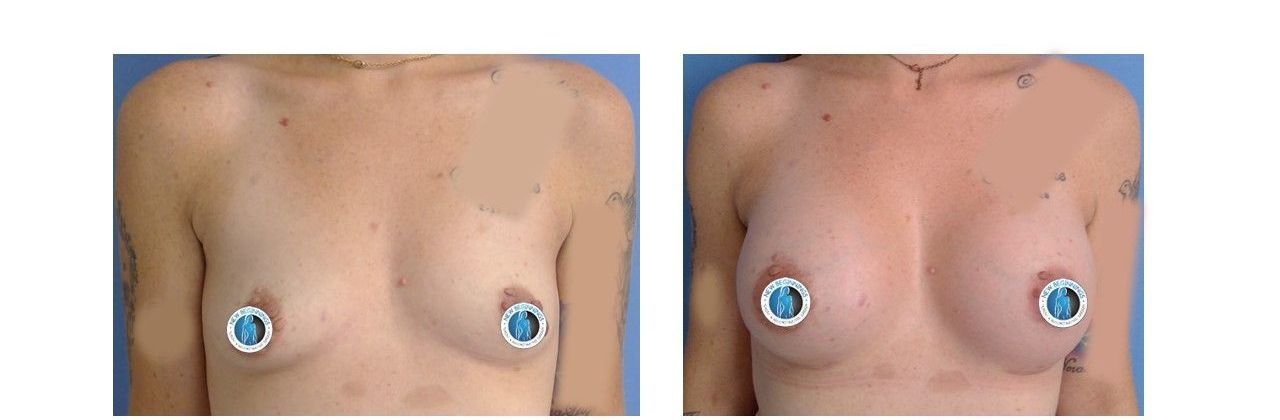 Augmentation Mastopexy