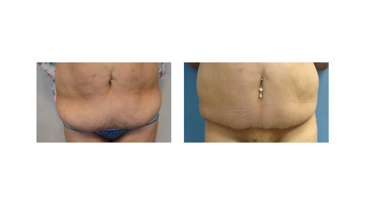 A before and after picture of a woman 's stomach.