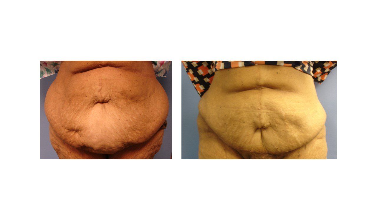 A before and after picture of a woman 's stomach.