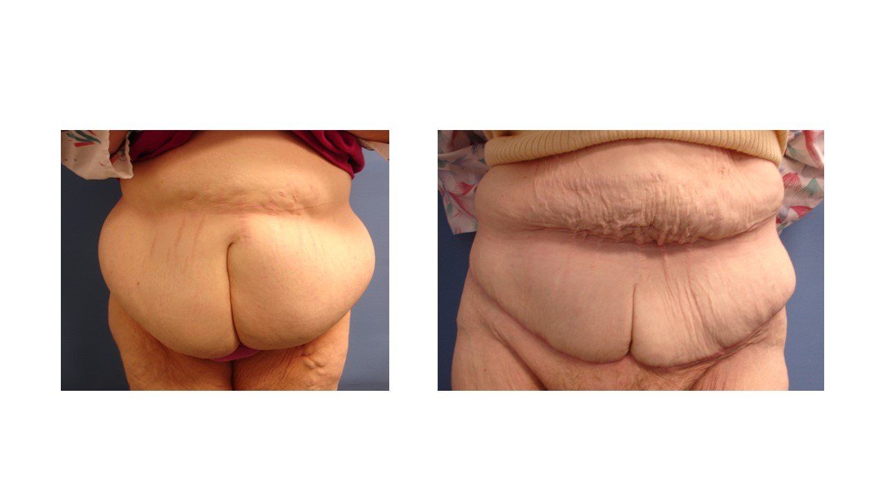 Abdominal Panniculectomy