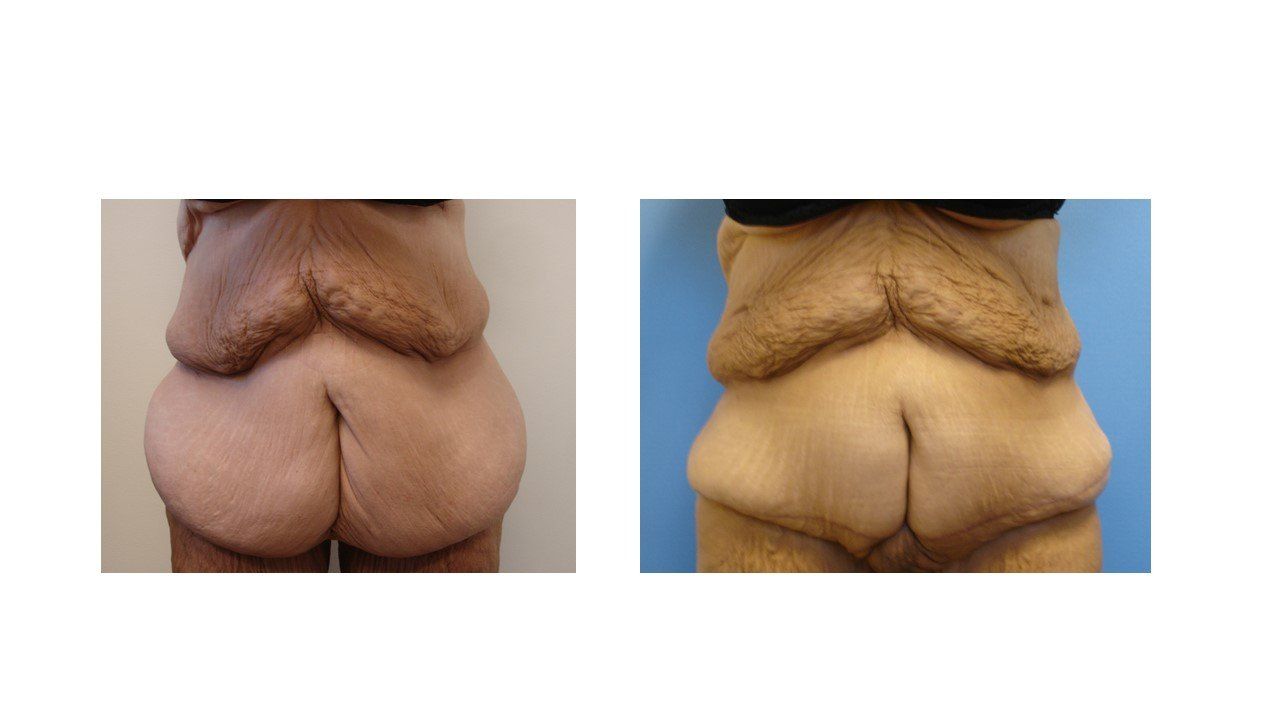 A before and after picture of a woman 's stomach.
