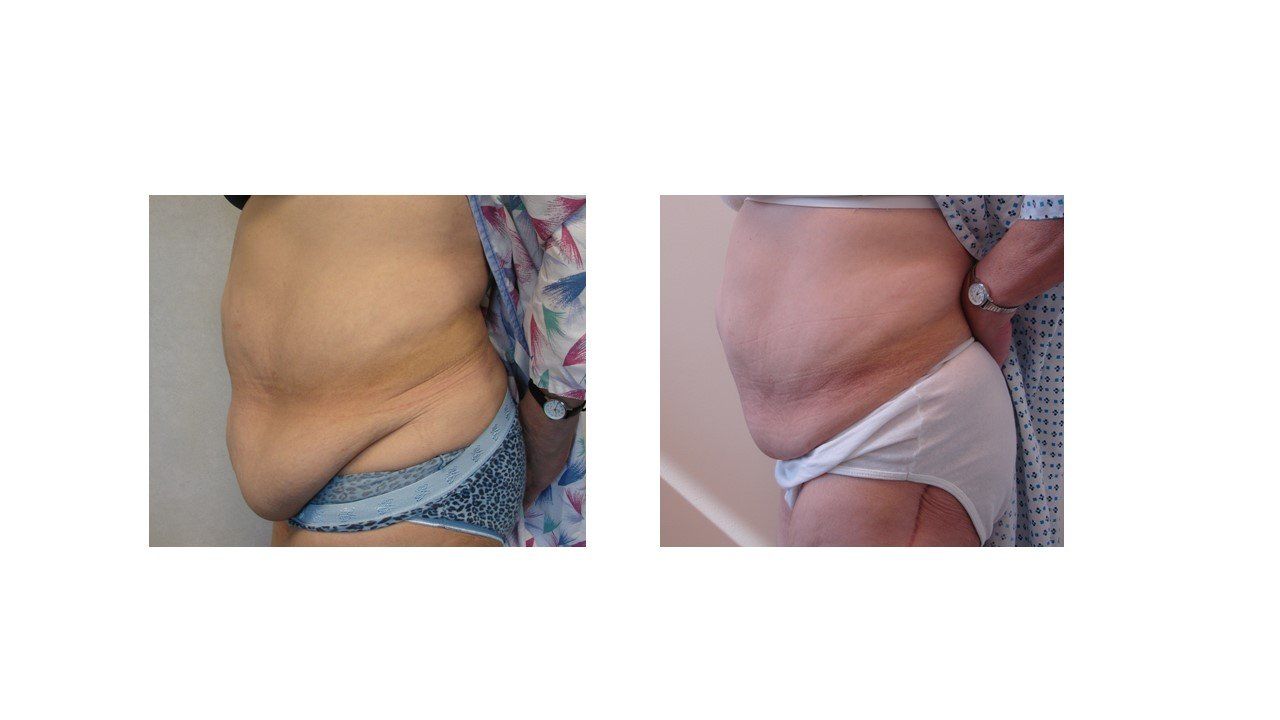A before and after picture of a woman 's stomach.
