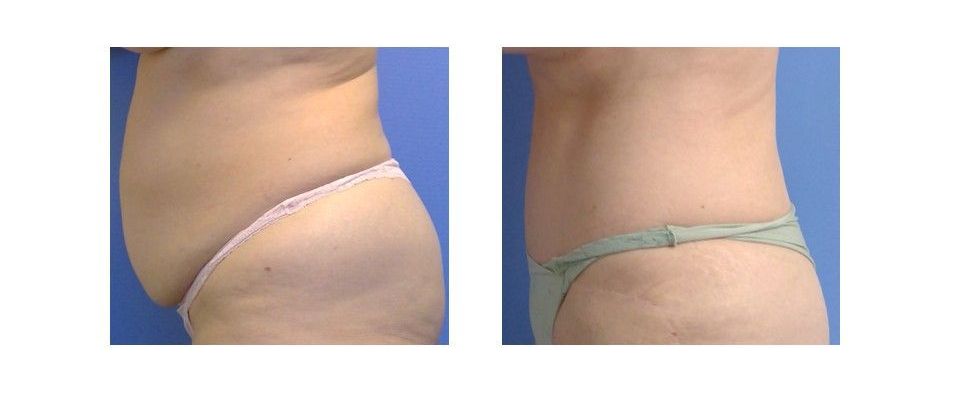 A before and after picture of a woman's stomach.