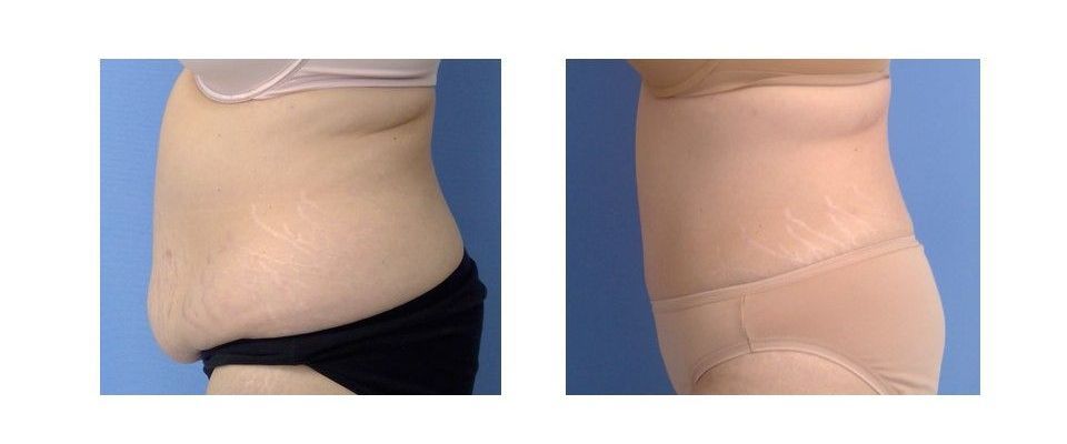 A before and after picture of a woman's stomach.