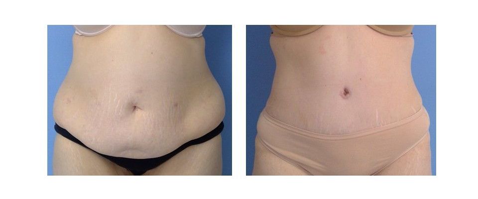 A before and after picture of a woman's stomach.