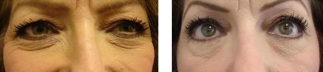 A before and after photo of a woman 's eyes.