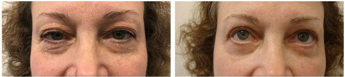 A before and after photo of a woman 's eyes.