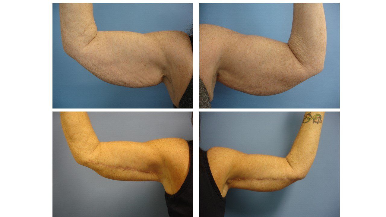 Four pictures of a woman 's arms before and after surgery