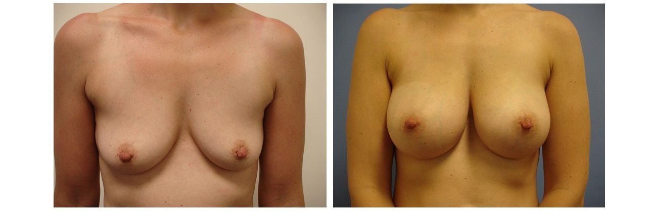 Breast Augmentation