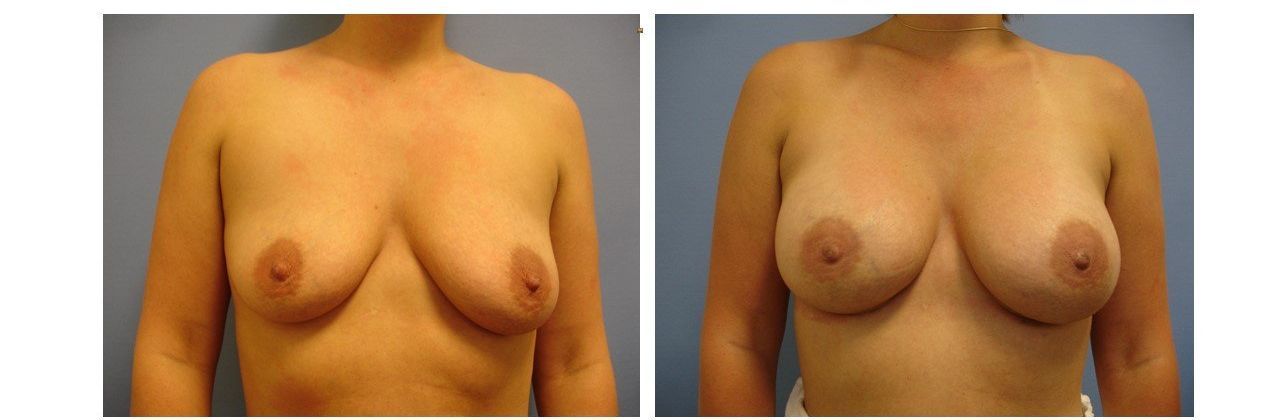 Breast Augmentation