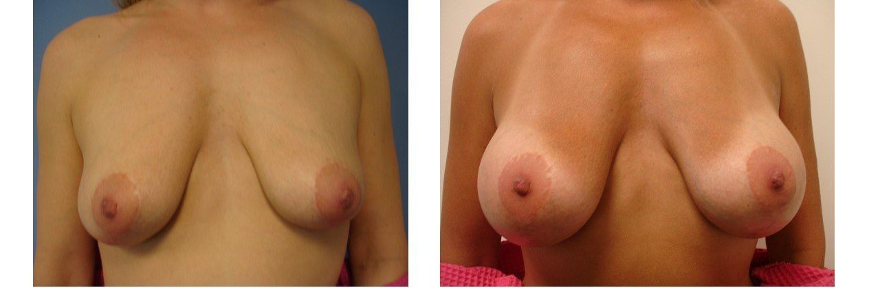 Breast Augmentation