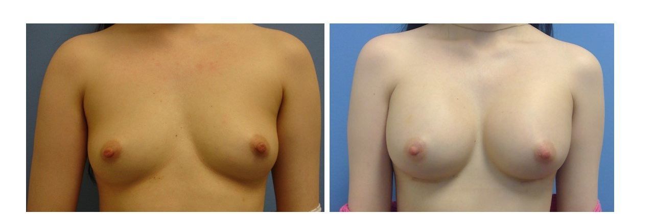 Breast Augmentation