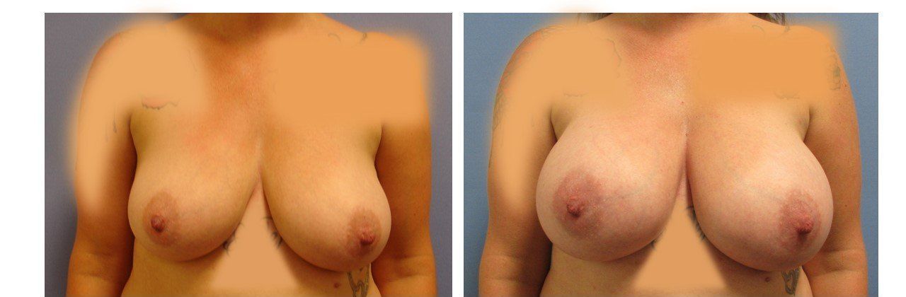Breast Augmentation