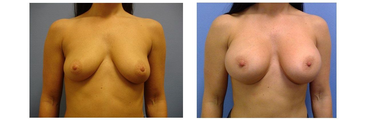 Breast Augmentation
