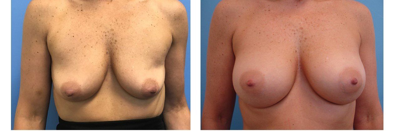 Breast Augmentation