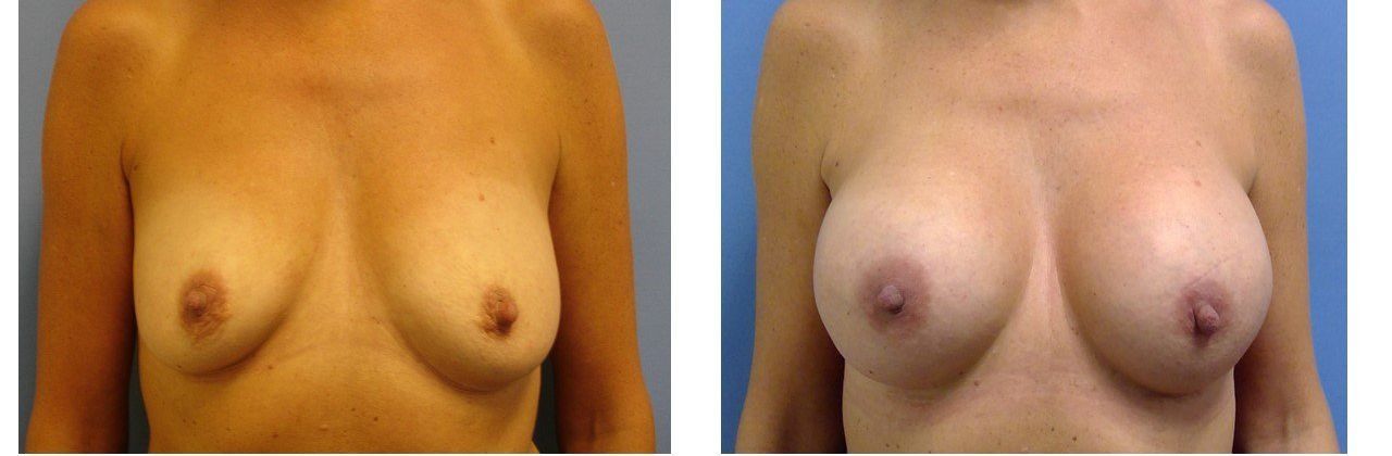 Breast Augmentation