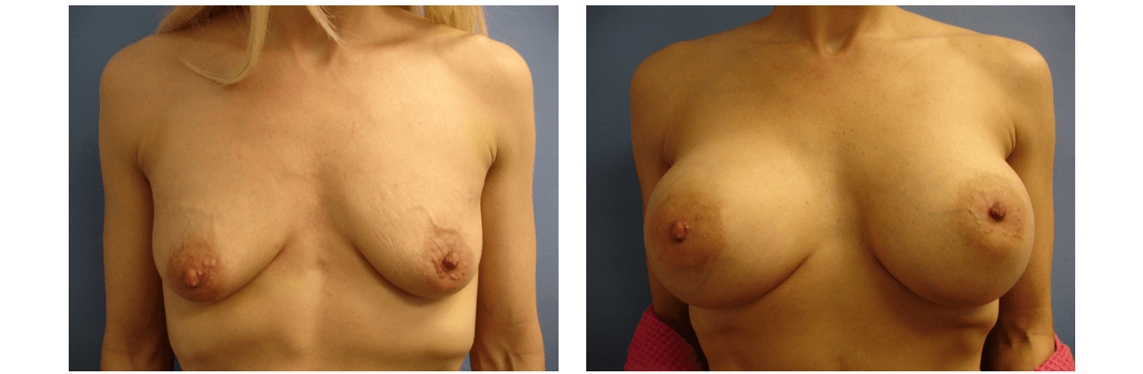 Breast Augmentation