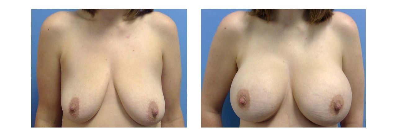 Breast Augmentation