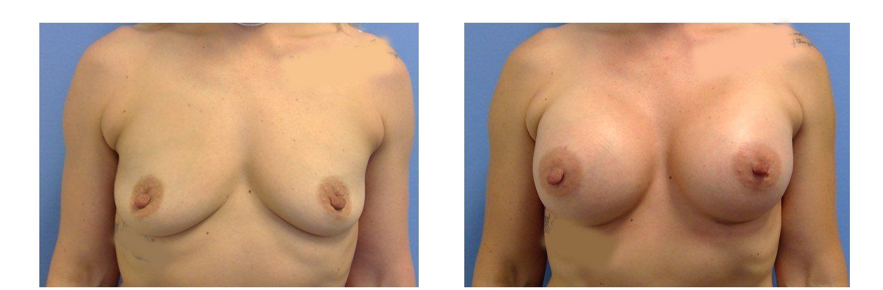 Breast Augmentation