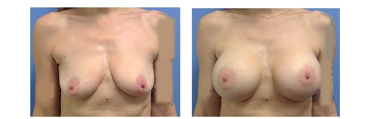 Breast Augmentation