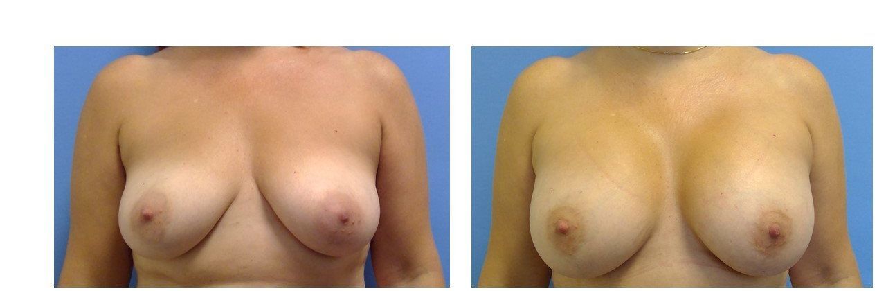 Breast Augmentation