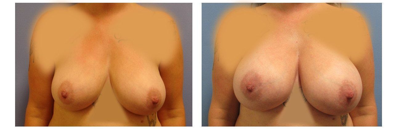 Breast Augmentation