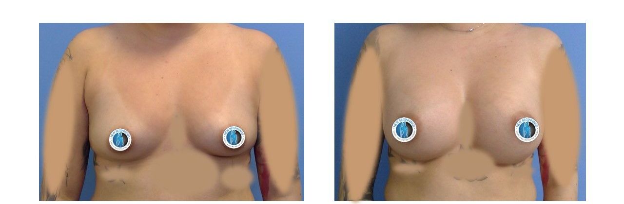 Breast Augmentation