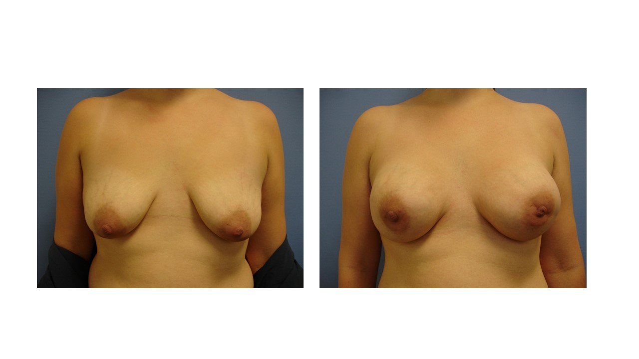 Breast Reconstruction