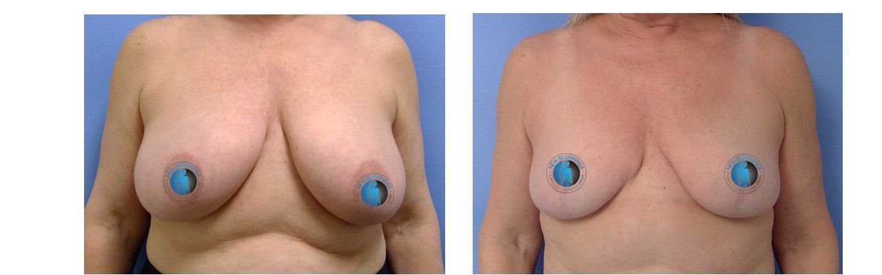 Breast reduction before and after