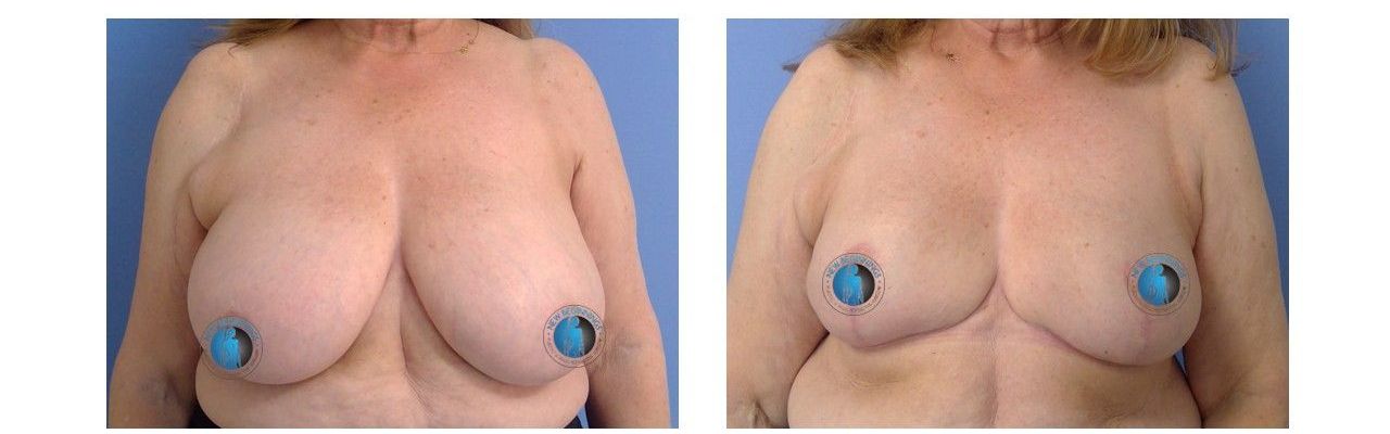 Breast reduction before and after