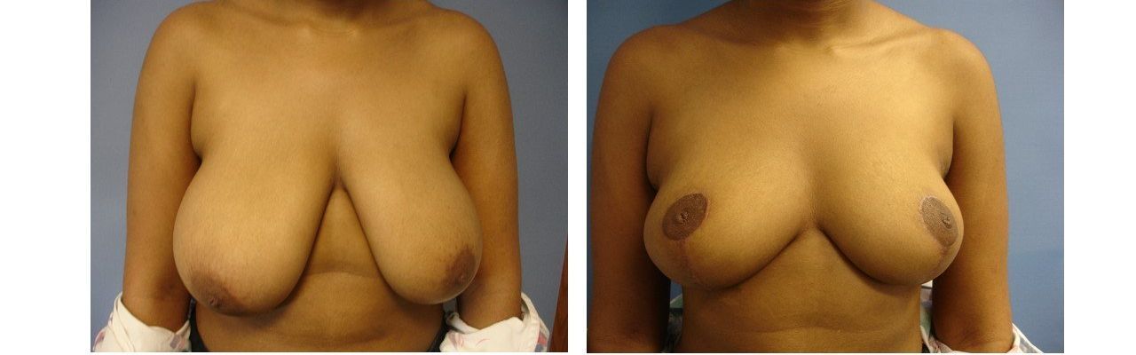 Breast Reduction