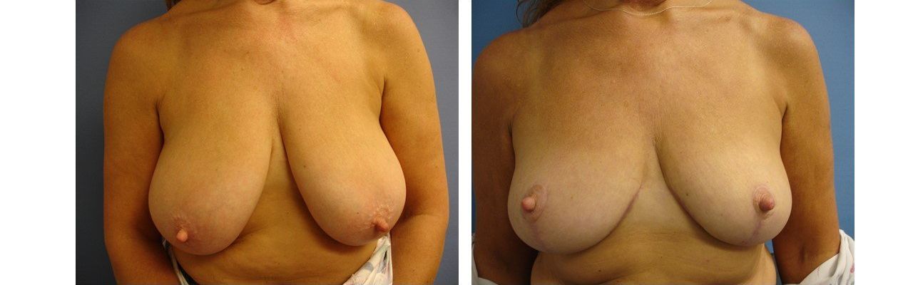Breast Reduction