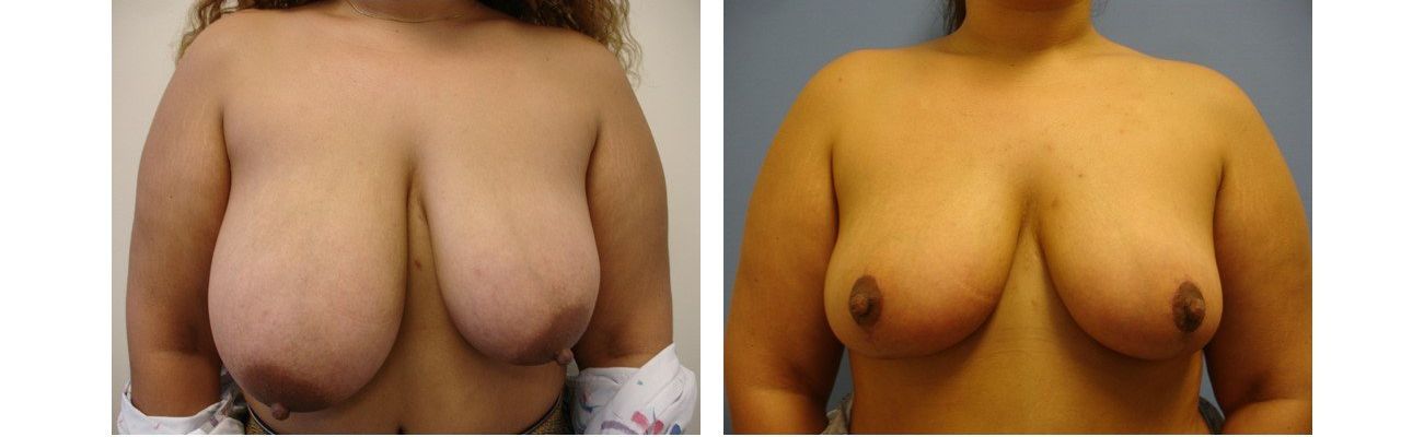Breast Reduction