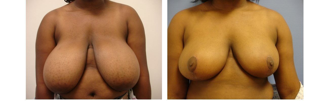 Breast Reduction