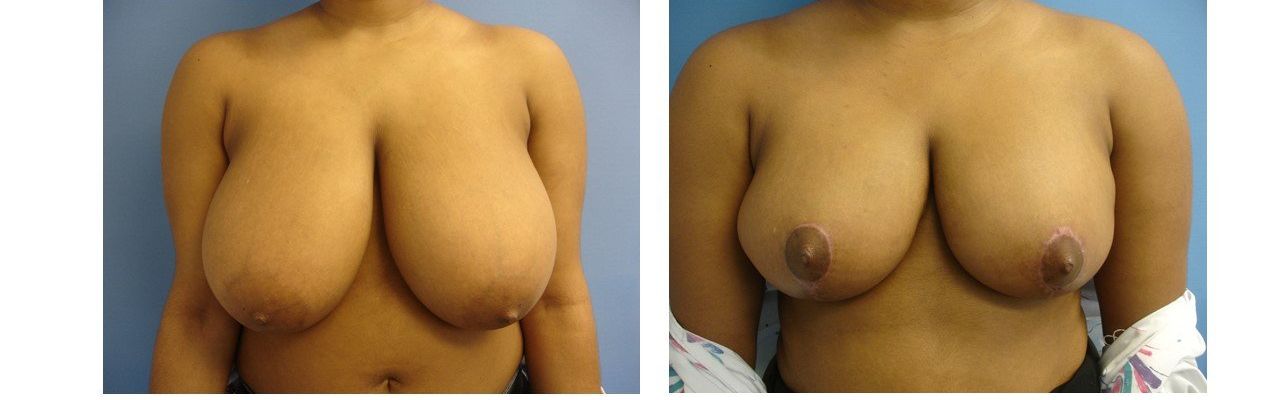 Breast Reduction
