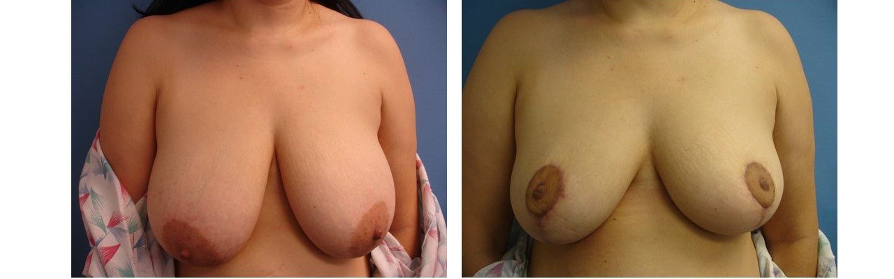Breast Reduction