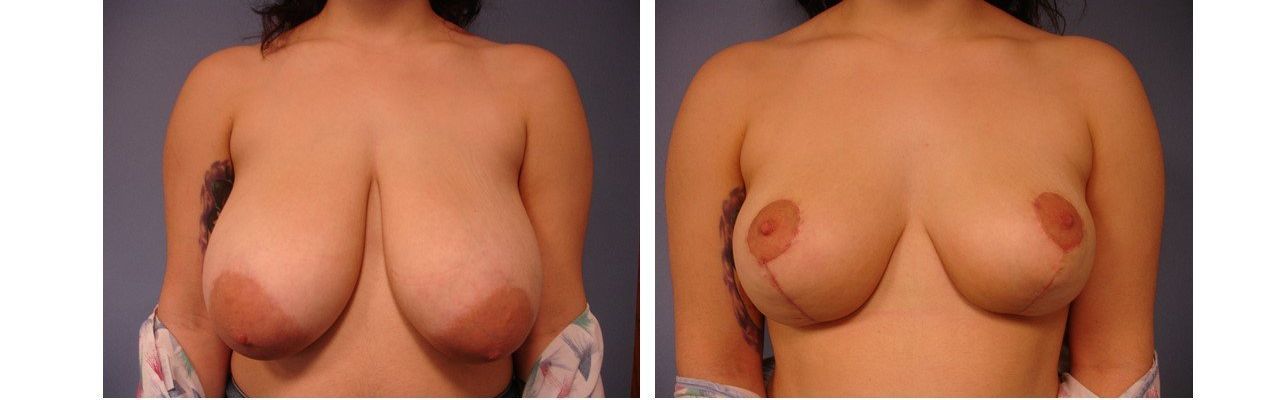 Breast Reduction