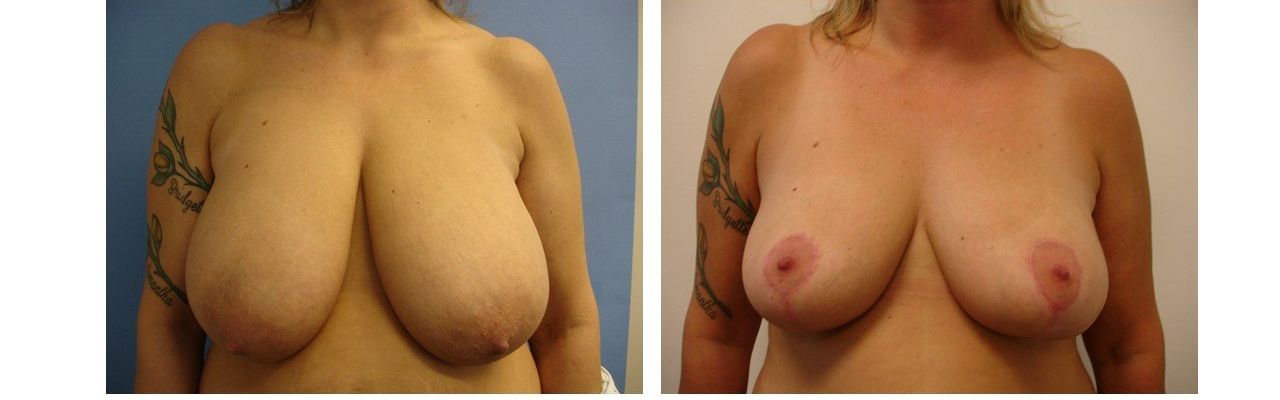 Breast Reduction