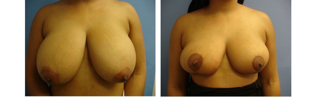 Before After