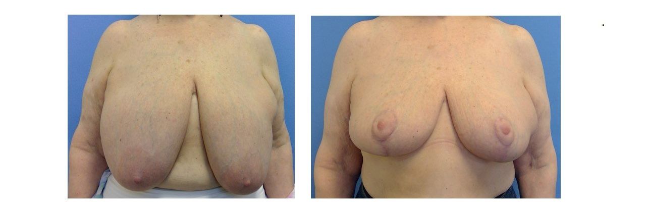 Breast Reduction - before after