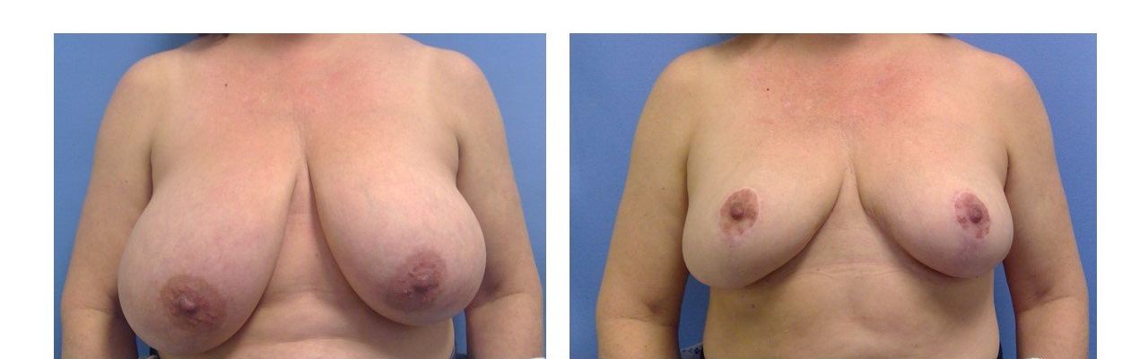 Breast Reduction