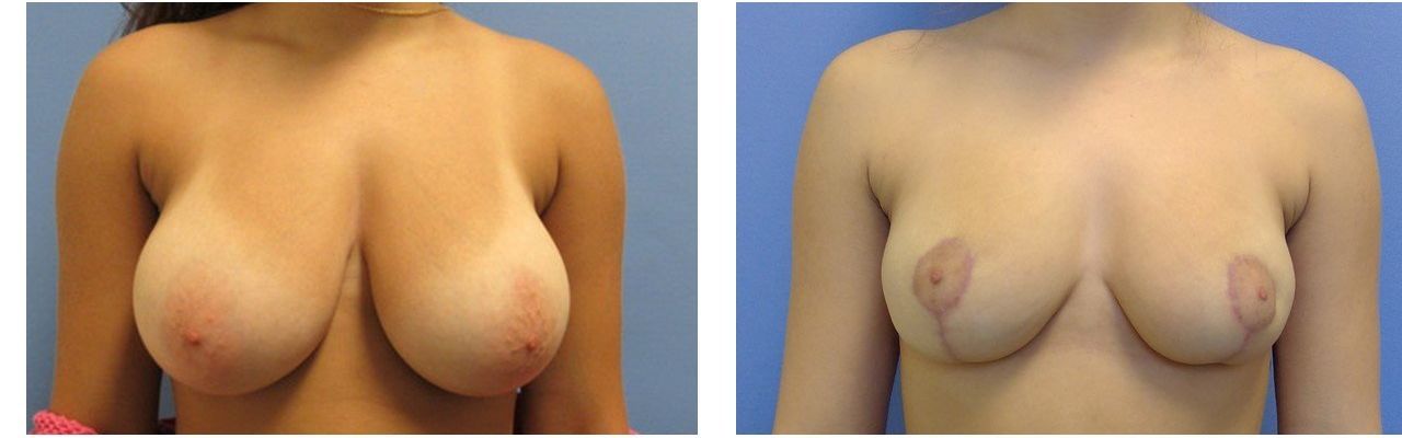 Breast Reduction