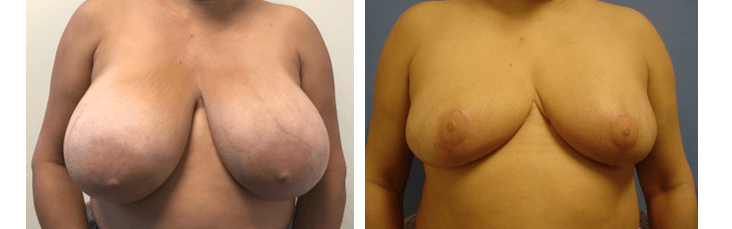 Breast Reduction