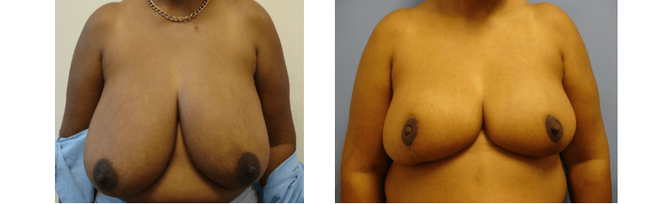 Before/After - Breast Reduction