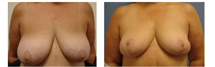 Breast Reduction