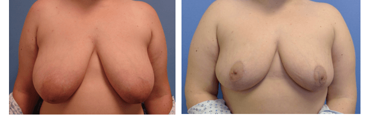 Before/After - Breast Reduction