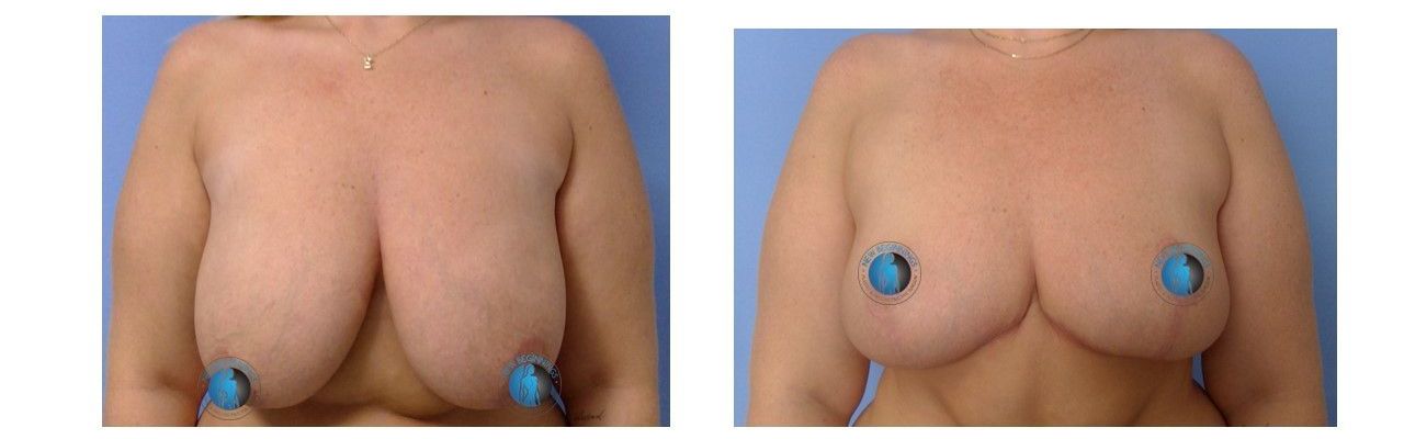 before and after images of breast reductions