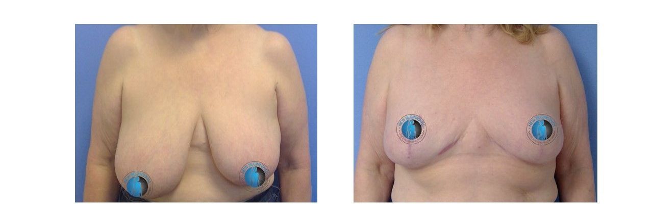 before and after breast reduction surgery