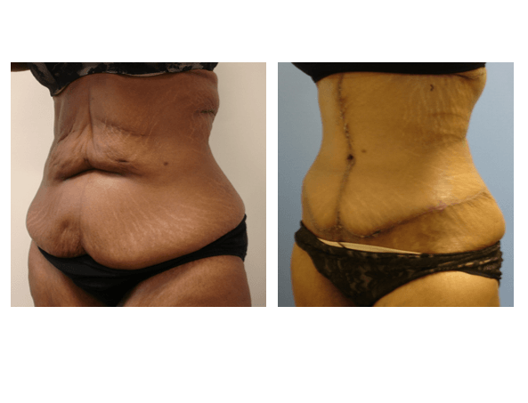 A before and after picture of a woman 's stomach